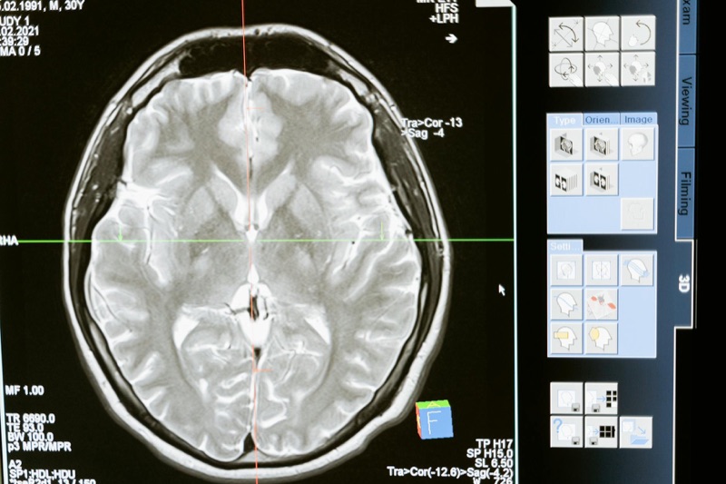 Brain Capital: Decoding the High-Stakes Landscape of Neurotechnology Investing